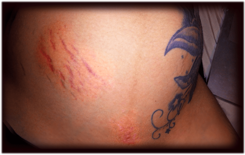 tiger woman stretch marks